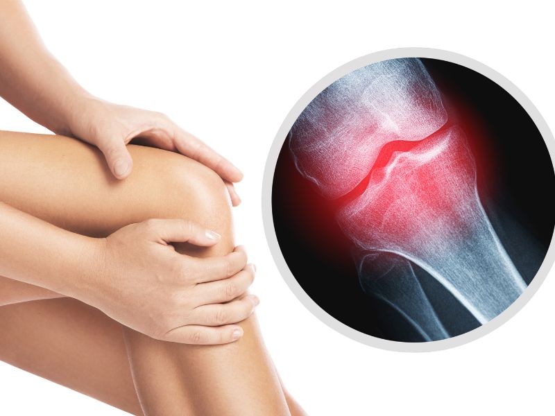 Embolização no Tratamento da Osteoartrose do Joelho: Uma Alternativa Inovadora para Alívio da Dor