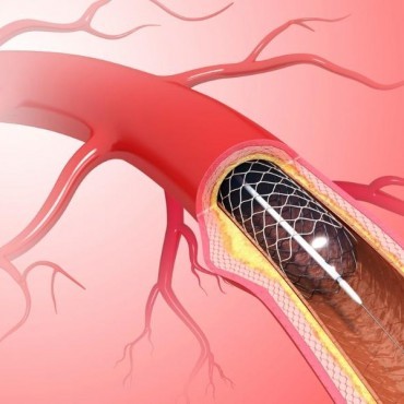 Quimioterapia Intra-arterial em Sapucaia do Sul - RS