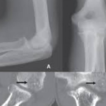 Osteoma Osteoide em Sapucaia do Sul - RS