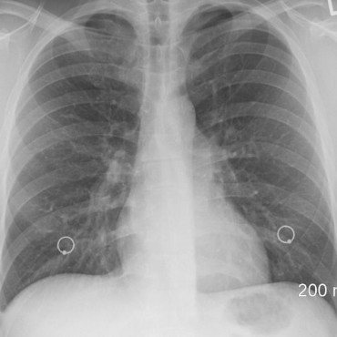 Biópsia pulmonar em Sapucaia do Sul - RS