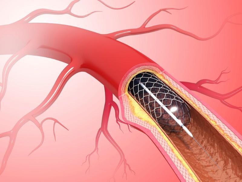 Quimioterapia Intra-arterial em Sapucaia do Sul - RS