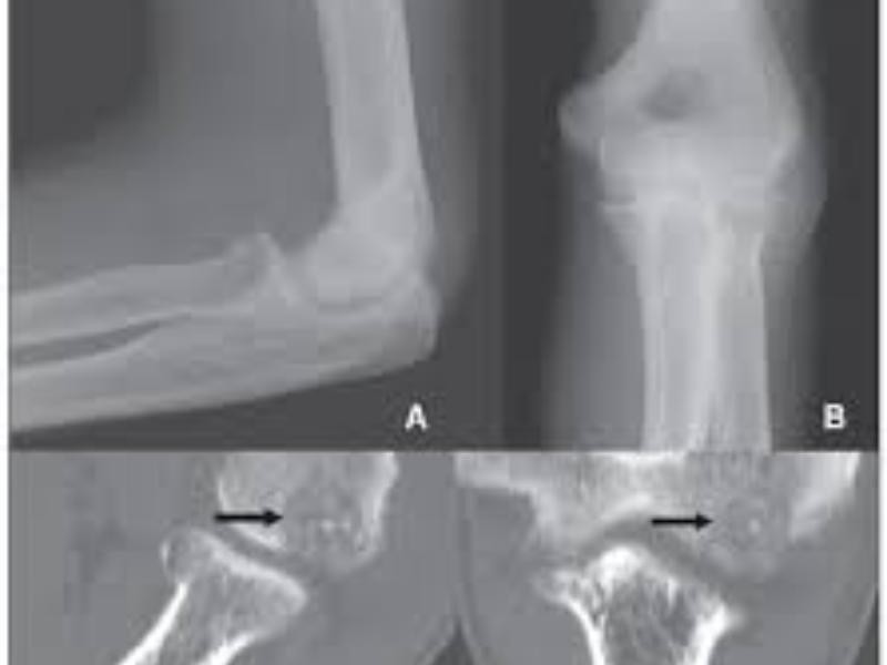 Osteoma Osteoide em Sapucaia do Sul - RS