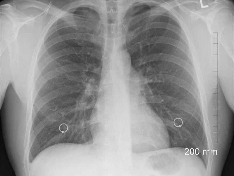 Biópsia pulmonar em Sapucaia do Sul - RS